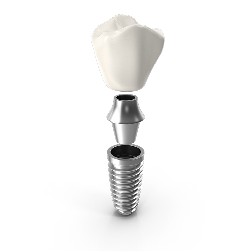 anatomy of a dental implant